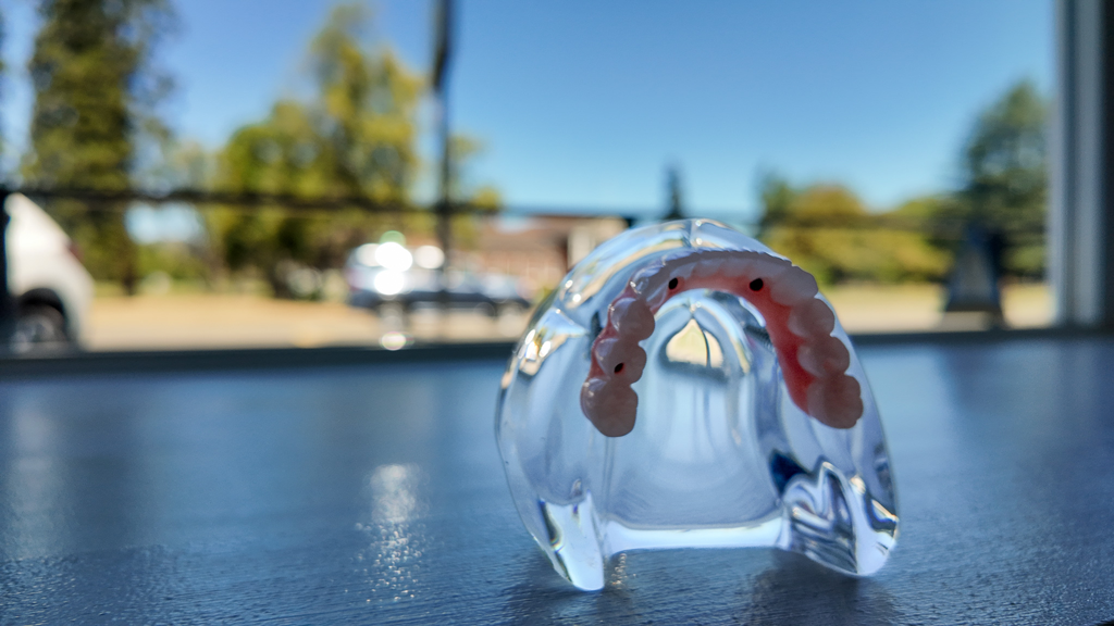 All on four denture model for implant retained dentures