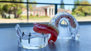 Cascade Denture, Implant Retained Dentures, Denture Model