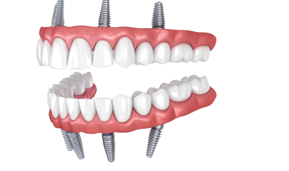 3D model of dental implants and dentures