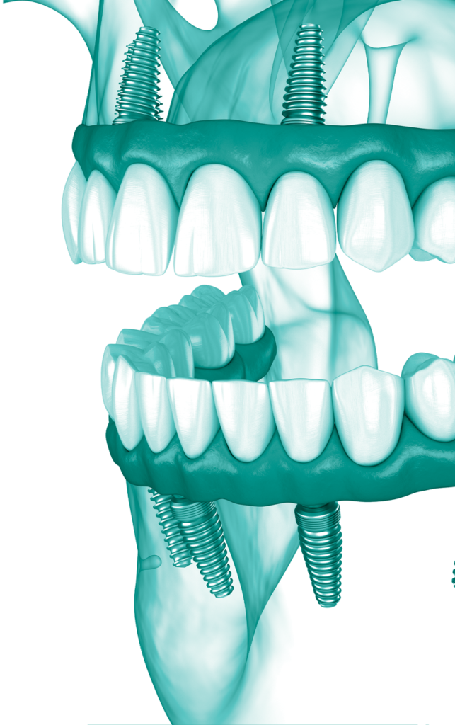 Illustration of All-On-4 dental implant system